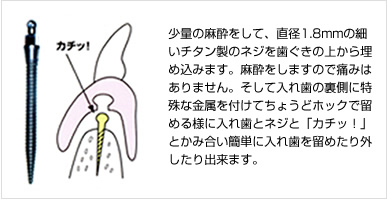 少量の麻酔をして、直径1.8mmの細いチタン製のネジを歯ぐきの上から埋め込みます。麻酔をしますので痛みはありません。そして入れ歯の裏側に特殊な金属を付けてちょうどホックで留める様に入れ歯とネジと「カチッ！」とかみ合い簡単に入れ歯を留めたり外したり出来ます。