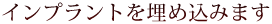 インプラントを埋め込みます